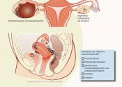 endometriose.jpg
