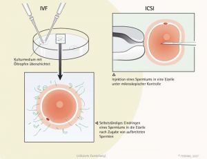Gegenbüberstellung IVF - ICIS