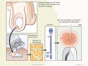 Hodenbiopsie zur Spermiengewinnung